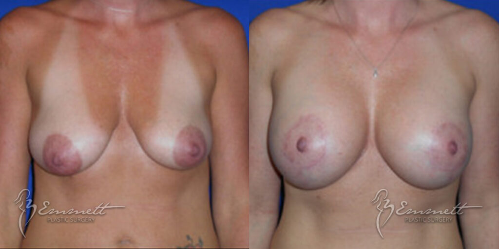 Before and after a breast lift with dr Emmett | emmett plastic surgery